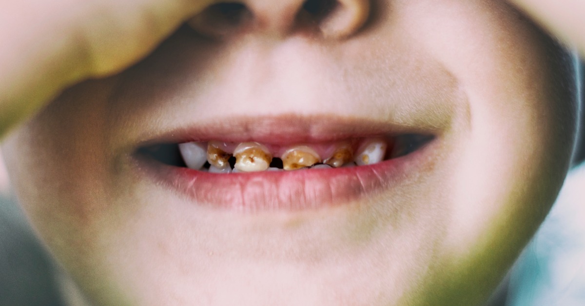 最新消息_不用拔牙為您治療嚴重蛀牙！